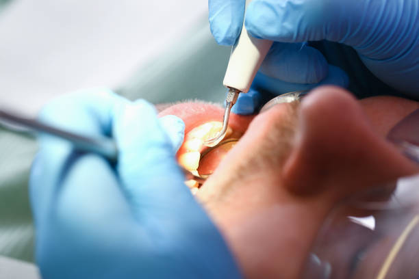 Best Knocked-Out Tooth (Avulsed Tooth) Treatment in Walnut Grove, CA
